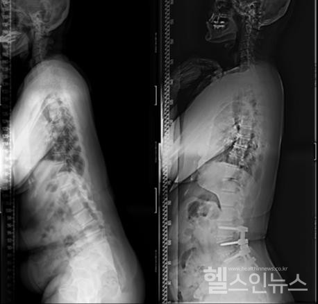 요부변성 후만증의 모습(왼쪽), 단분절 유합술 후의 모습