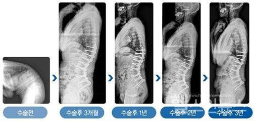 심한 노인성 후만변형으로 수술을 받은 78세 환자 (여)는 수술 3년 후에도 허리곡선이 잘 유지되고 있다.