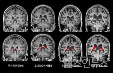 뇌 영상에서 맥락얼기의 부피(빨간색)가 치매가 진행함에 따라 더 증가한 것을 확인할 수 있다.