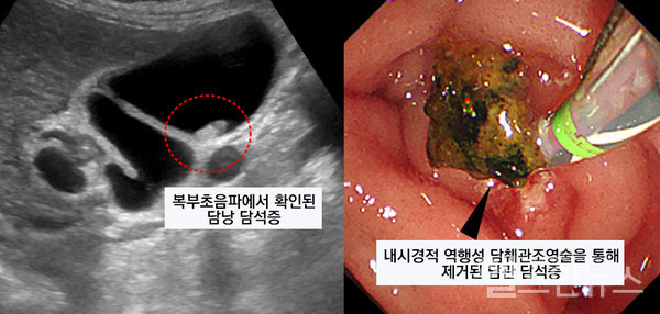 (좌)복부초음파, (우)내시경적 역행성 담췌관조영술(ERCP)를 통해 확인된 담석증 (제공 순천향병원