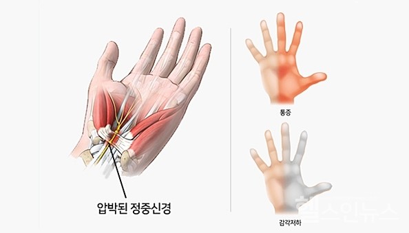 손목터널 증후군 증상이 진행 중인 손 (강남베드로병원 제공)