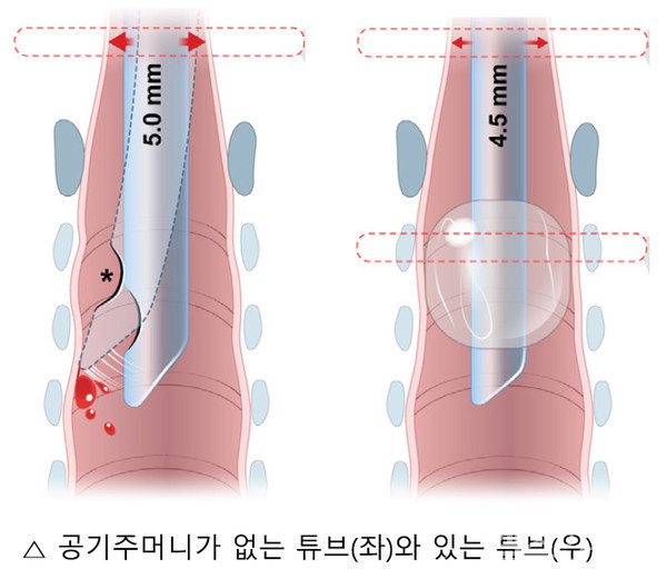 기관 내 삽관 튜브 모양