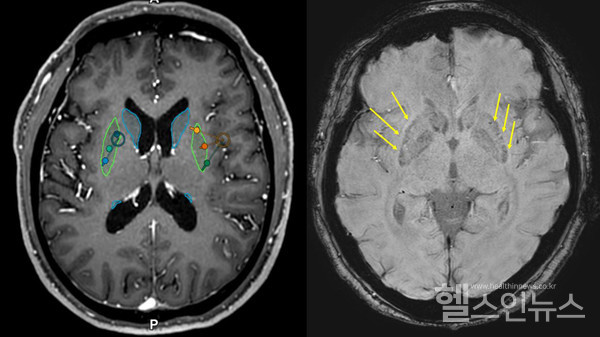 이식 전(왼쪽)후(오른쪽) MRI, 이식 후 MRI에서 성공적으로 세포가 이식된 부위를 확인할 수 있다(화살표)