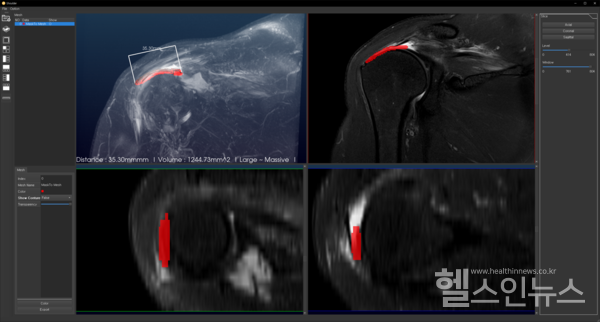 Multiplanar reformation view. 빨간색 영역은 자동으로 분할된 RCT 병변을 나타낸다. 분할된 영역은 다중면(coronal, axial, sagittal) 방향으로 자유롭게 제어해 볼 수 있다.