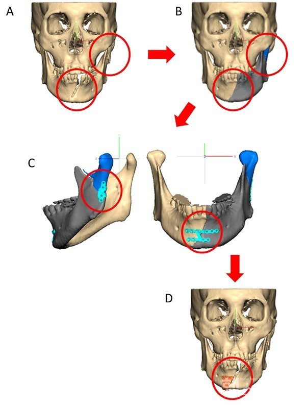 환자 맞춤형 안골절수술 모식도 (A) 환자의 CT를 3차원적으로 재구성  (B) 가상 수술로 골절편을 재위치로 정복한 모습(C) 환자 맞춤형 금속판 디자인        (D) 환자 맞춤형 수술 가이드 디자인