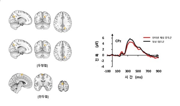 기능적 MRI 검사 결과 인터넷 게임 중독군은 정상대조군들보다 두정엽과 전두엽 부위에서 뇌 활성이 증가했다(좌측 사진). 청각 자극에 대한 뇌파 신호의 진폭은 인터넷 게임 중독군이 정상대조군보다 감소했다(우측 그래프).