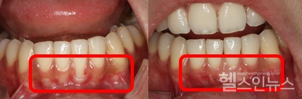 잇몸이식술을 통해 노출된 치근면을 덮기 전(왼쪽)과 치료 후 모습(오른쪽)