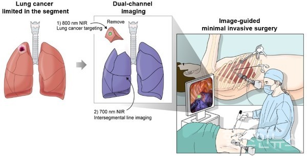 이중 형광영상을 활용한 폐암 정밀 수술법’ 적용 예시 그림