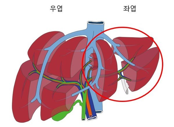 수혜자 간 이식 위치. 빨간 동그라미 표시된 부분이 수혜자가 절제받은 좌측 간미엽이다